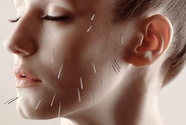 TMJ relief acupuncture salt lake city